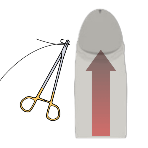 切らない包茎手術