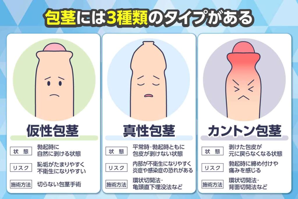 種類別包茎のタイプ