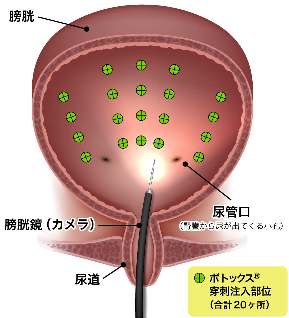 ボツリヌス毒素膀胱壁内注入療法