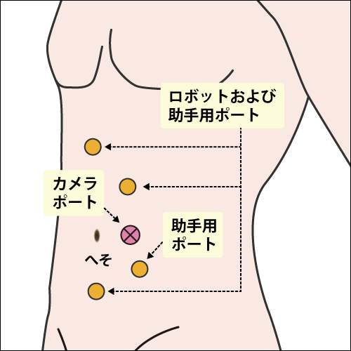 左ロボット腎尿管全摘術（腹腔内アプローチ）