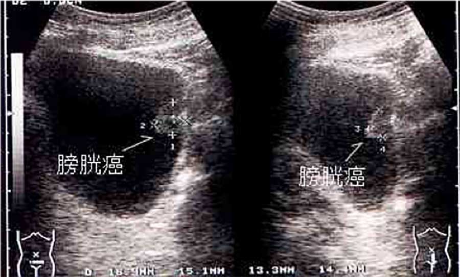 腹部超音波検査エコー画像２