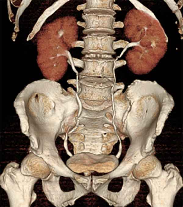 CT-Urography (シーティーウログラフィー)画像