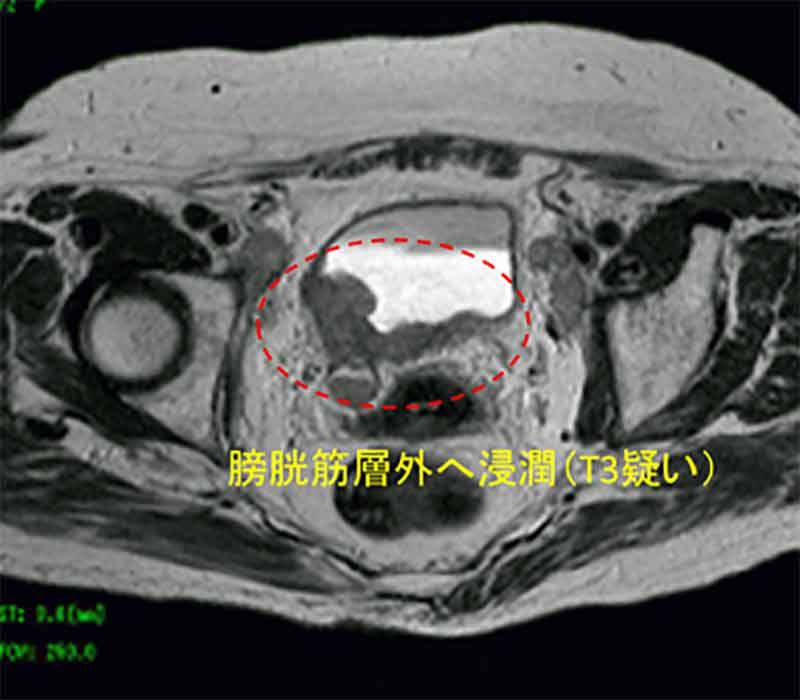 MRI検査膀胱周囲脂肪組織まで浸潤（Ｔ３）画像