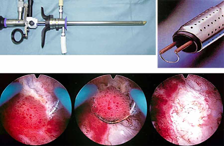 経尿道的膀胱腫瘍切除術（TUR-BT）