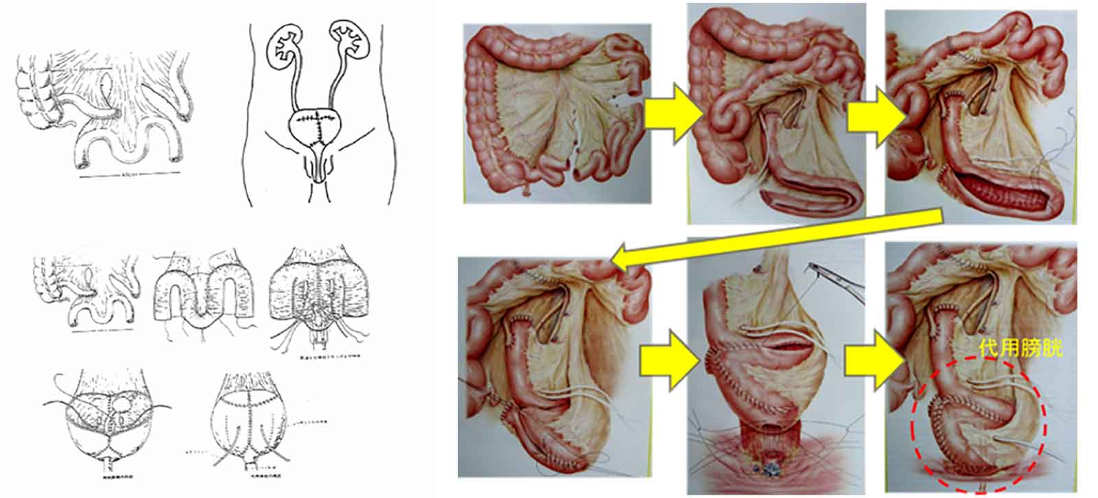 自然排尿型尿路変更術（代用膀胱）