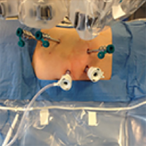 ロボット支援下腎部分切除術(RAPN)