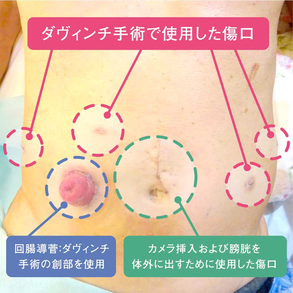 ロボット支援下根治的膀胱全摘除術とは？ | 泌尿器科 | 医療法人社団實 