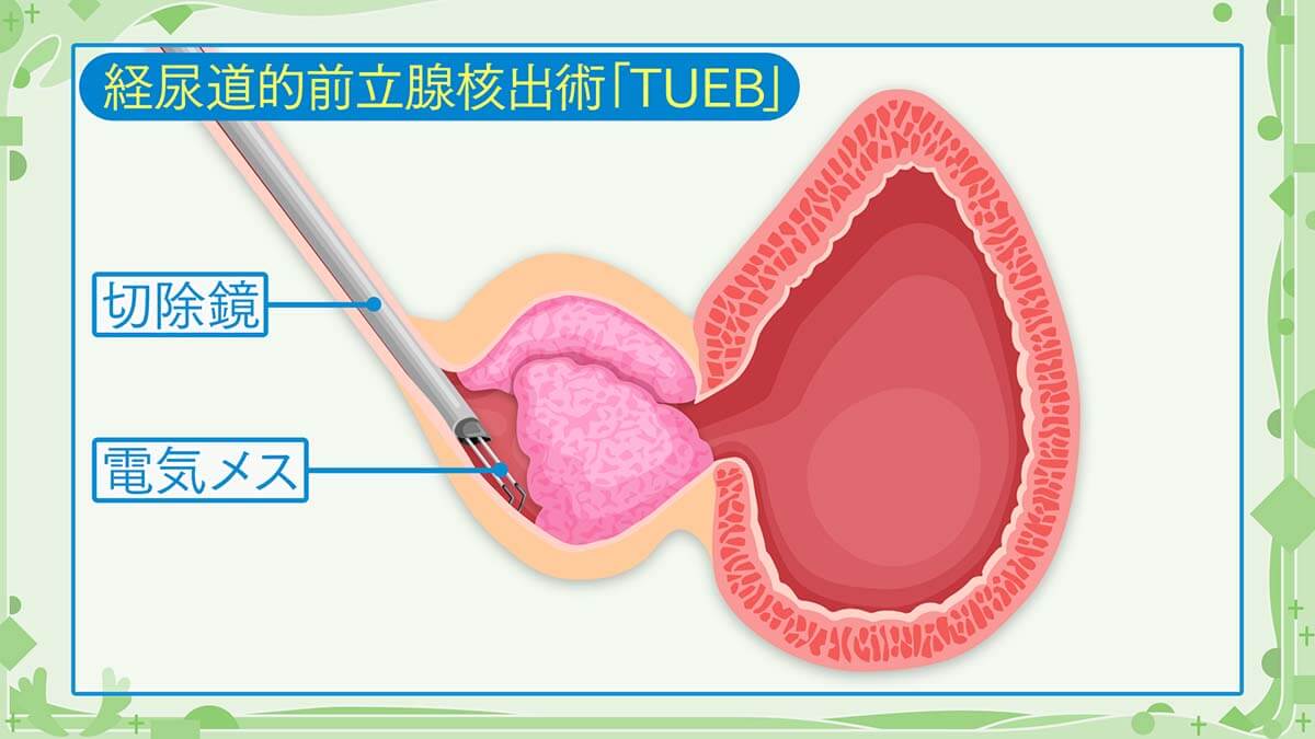 経尿道的前立腺核出術（TUEB）