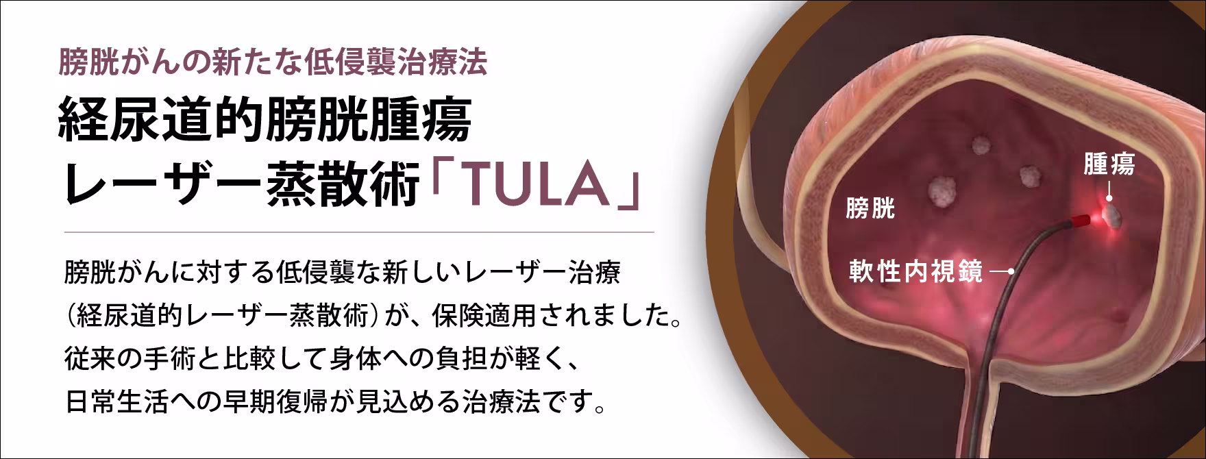 経尿道的膀胱腫瘍レーザー蒸散術「TULA」