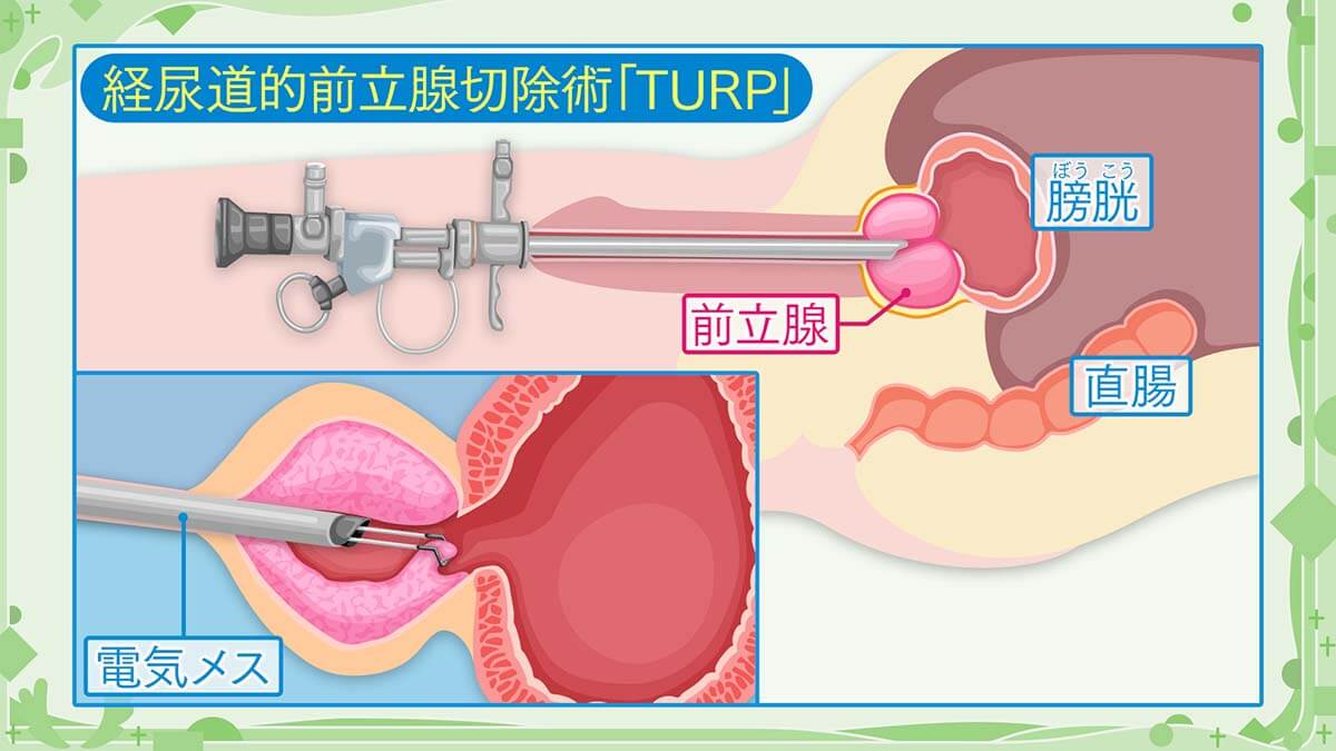 生理食塩水潅流(かんりゅう)経尿道的前立腺切除術(bipolar-TURP)