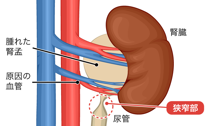 移行上皮がんの潜在的な兆候を認識する