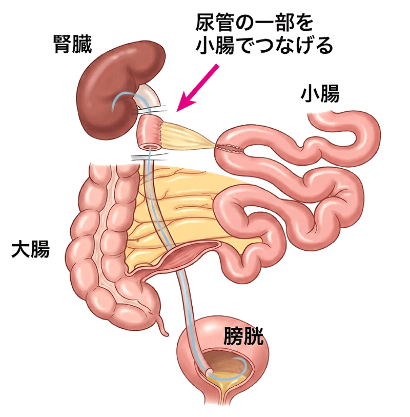 腸管を利用した修復