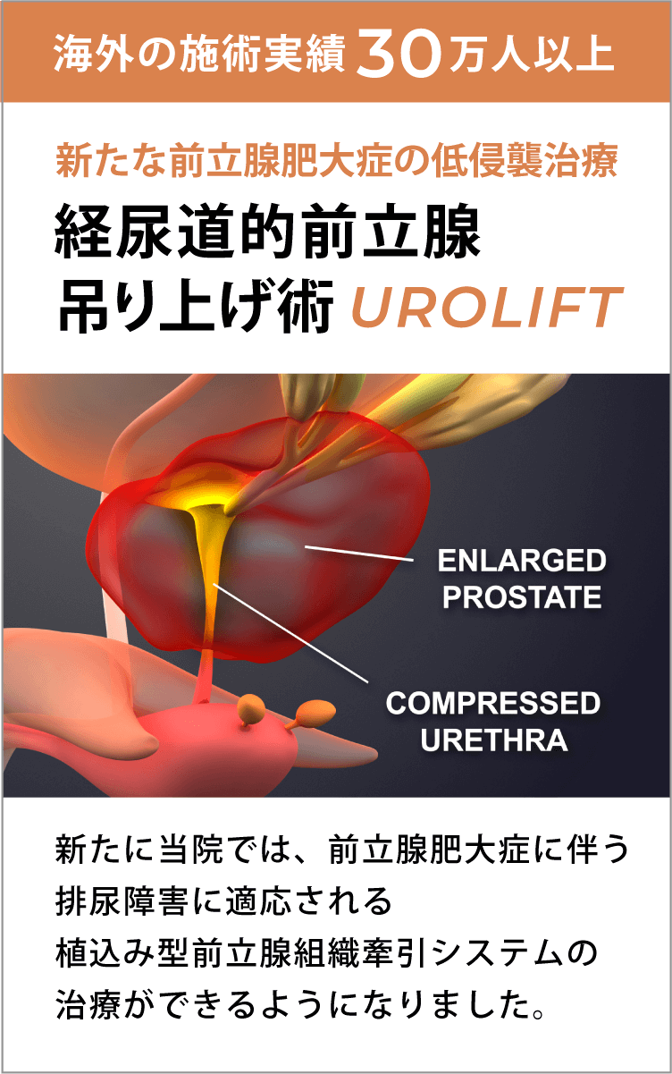 経尿道的前立腺吊り上げ術(Urolift)