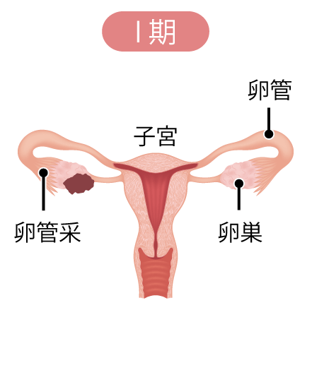 卵巣腫瘍の病期Ⅰ期