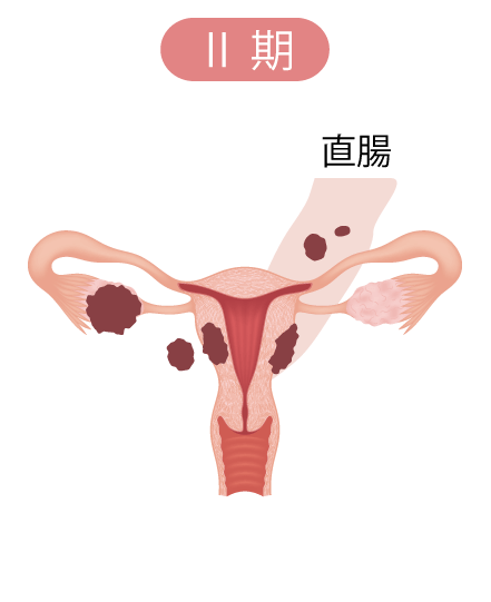 卵巣腫瘍の病期Ⅱ期