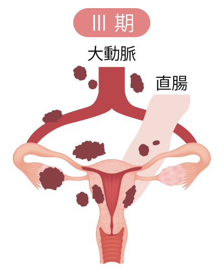 卵巣腫瘍の病期Ⅲ期