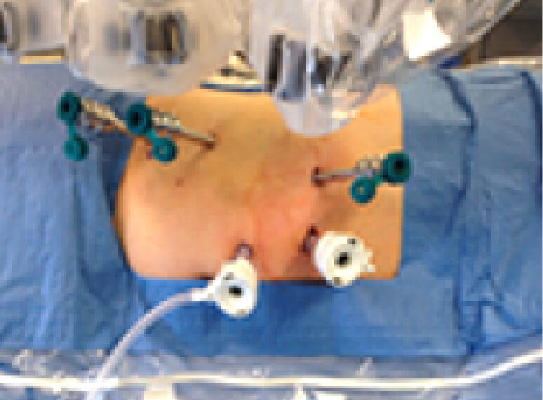 東京国際大堀病院でのロボット支援腎部分切除術