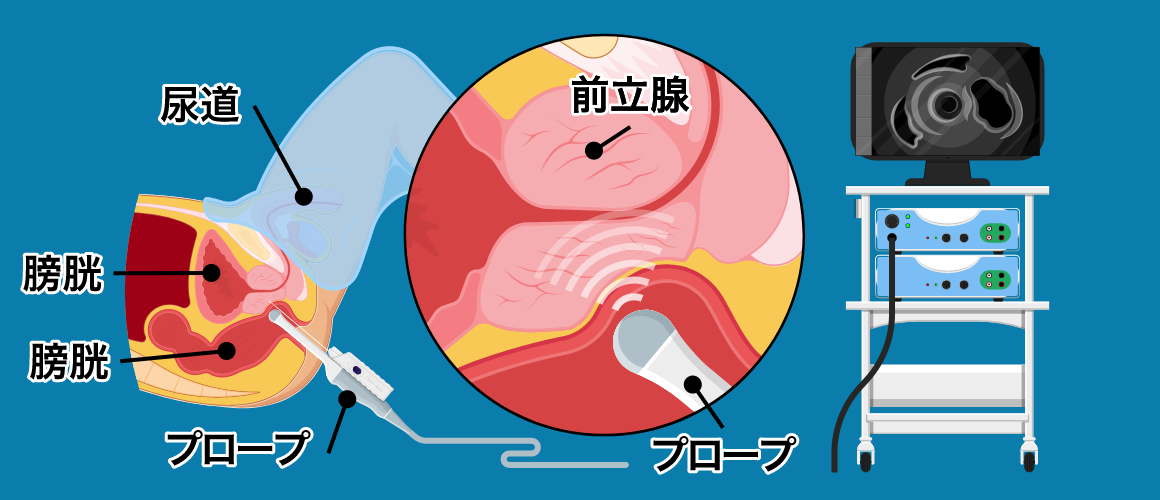 前立腺がんはCTスキャンで見つかりますか?