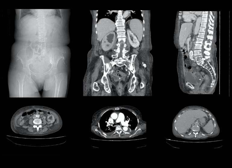 腎臓結石を診断するための CT スキャンはどの程度正確ですか?