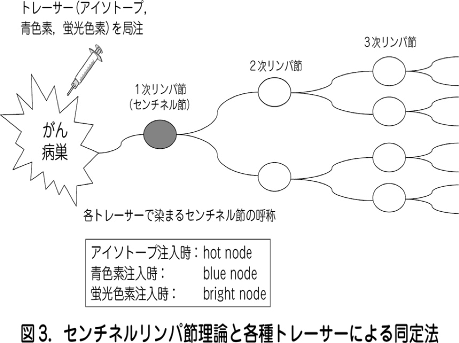 センチネルリンパ節理論と各種トレーサーによる同定法
