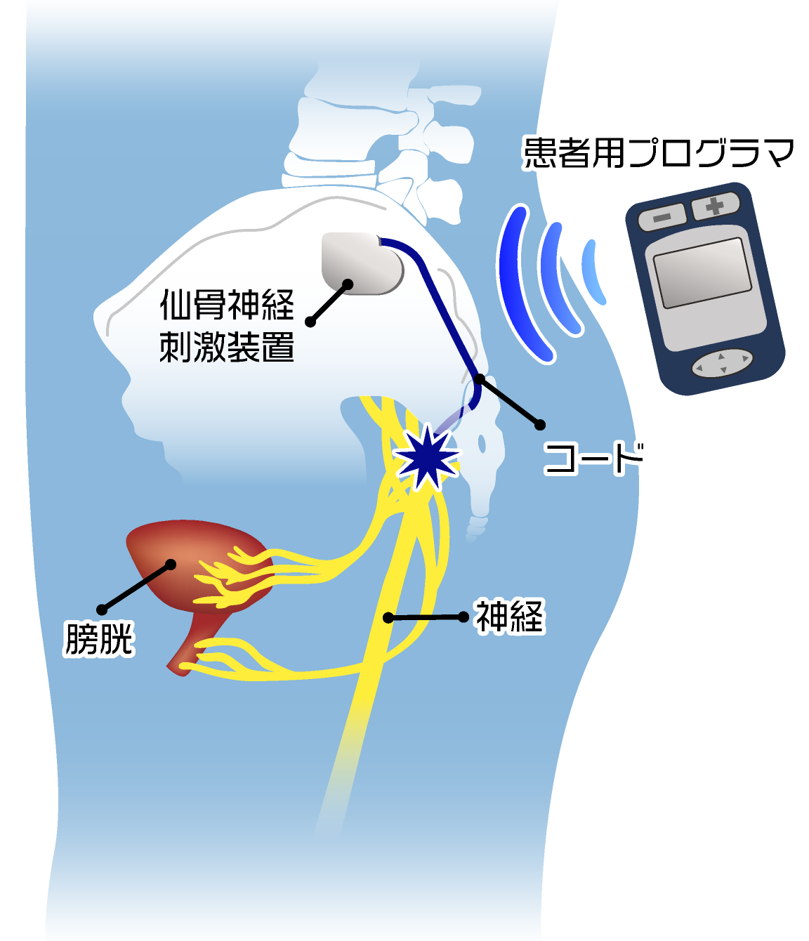 過活動膀胱の新しい治療法 仙骨神経刺激療法（SNM）
