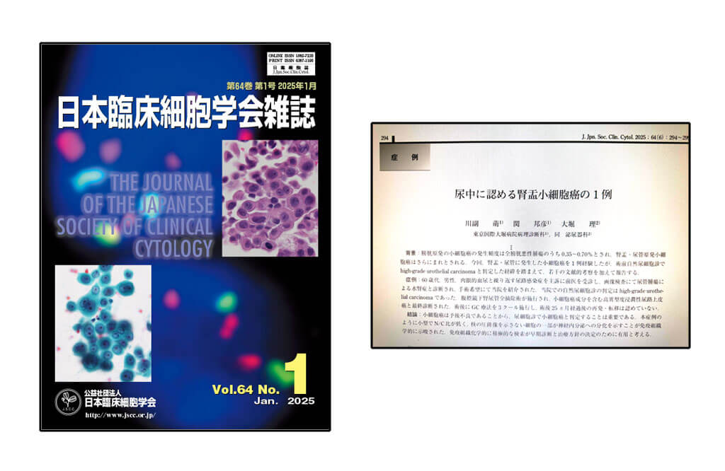 日本臨床細胞学会雑誌に論文が発表されました。