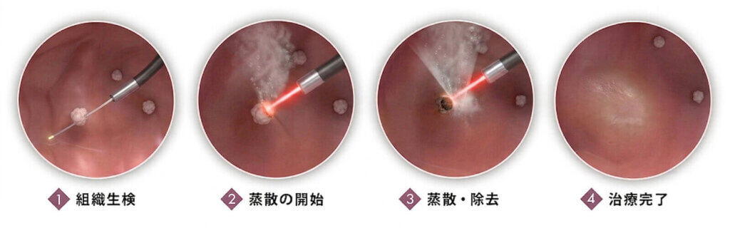 経尿道的膀胱腫瘍レーザー蒸散術「TULA」の治療工程