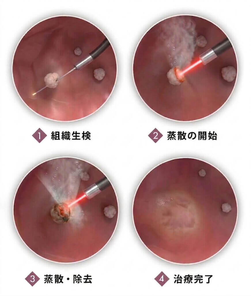経尿道的膀胱腫瘍レーザー蒸散術「TULA」の治療工程